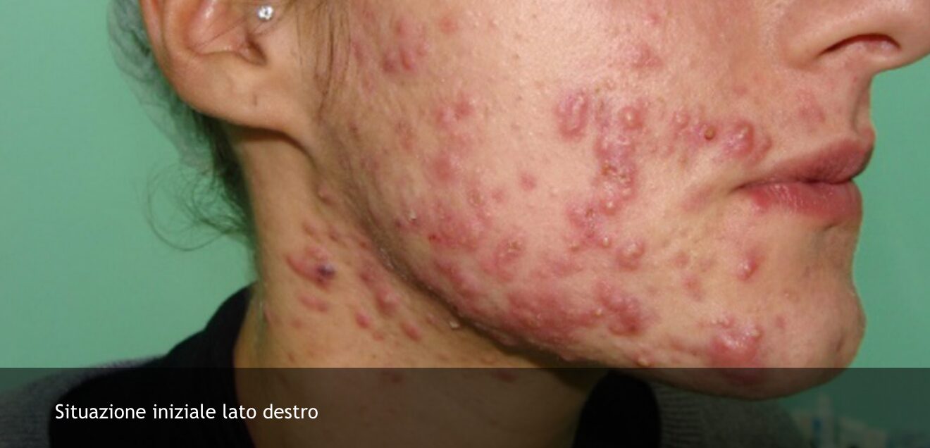acne 1 di 6