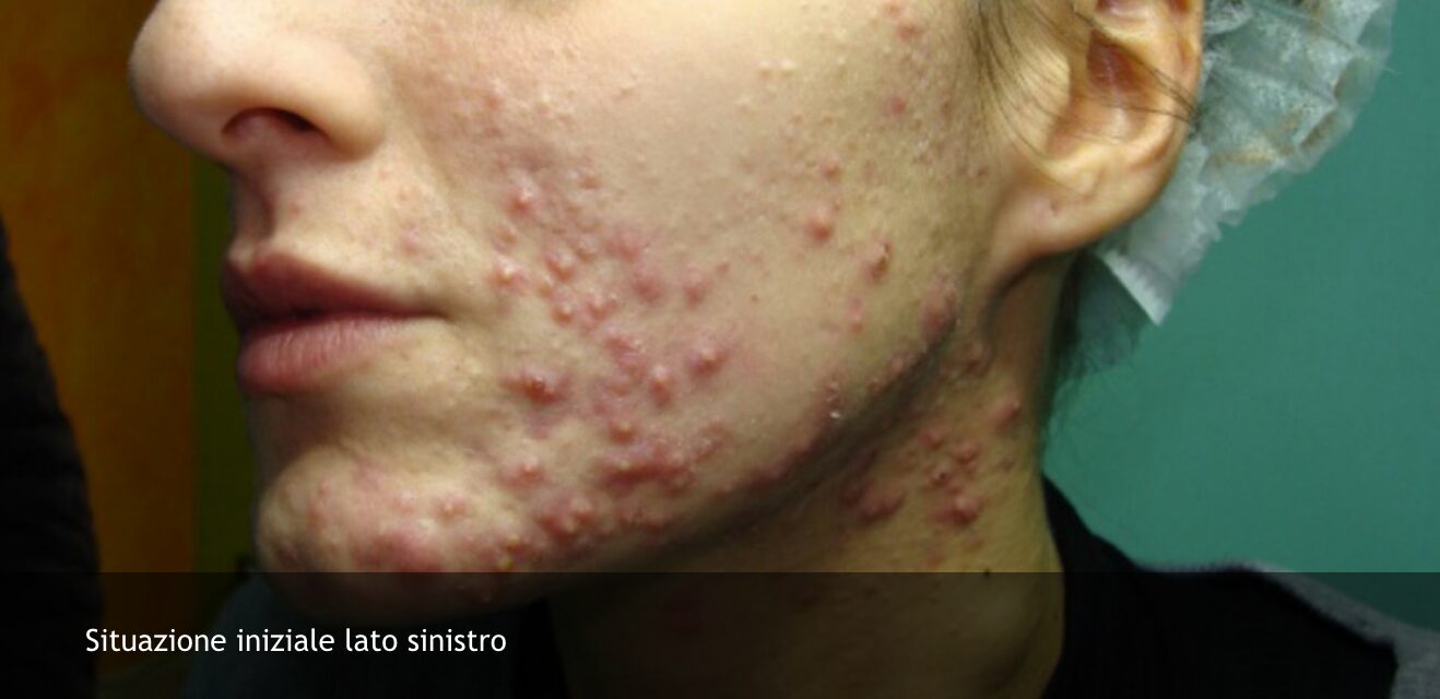acne 2 di 6