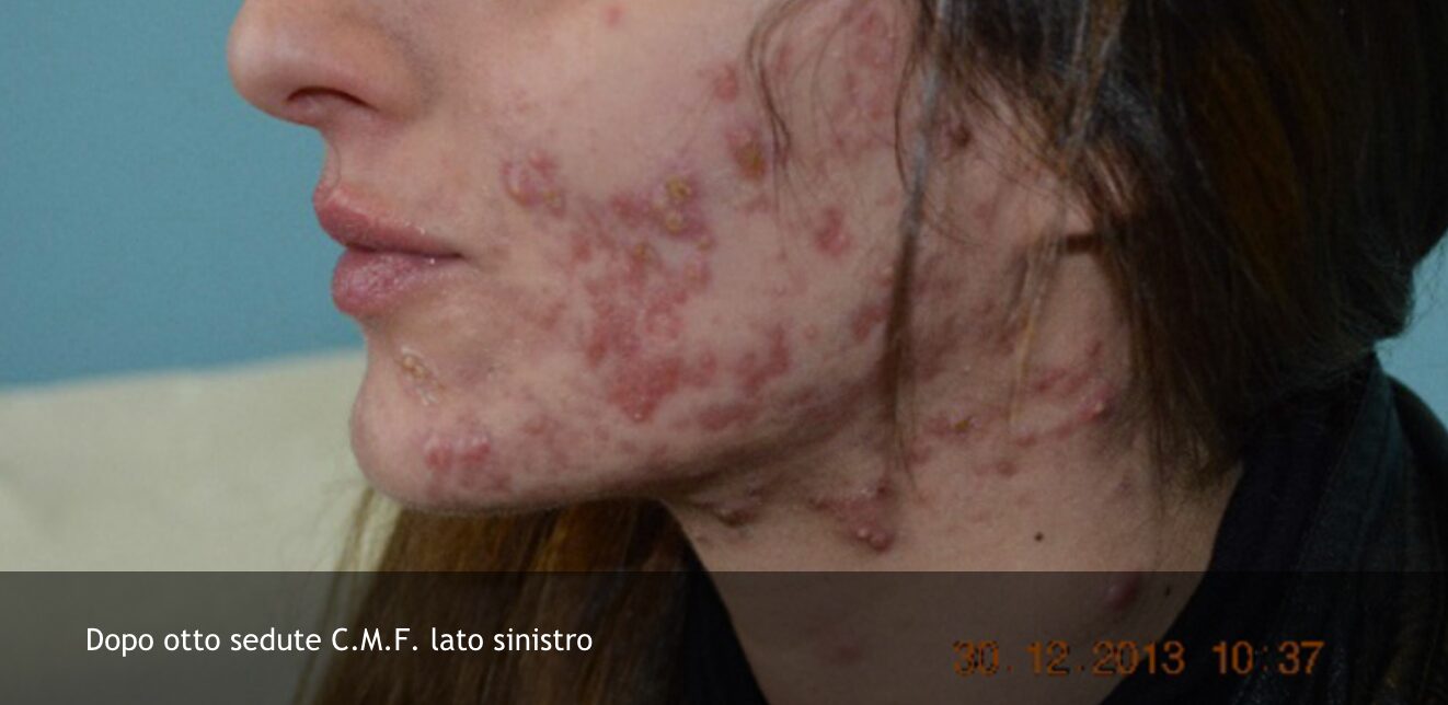 acne 4 di 6